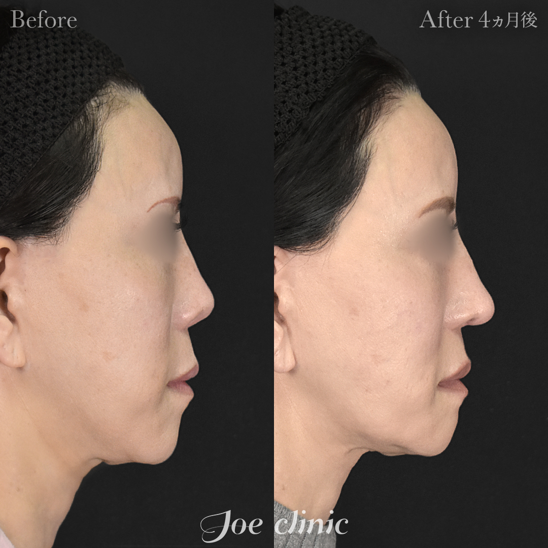 【50代女性・他院修正】他院鼻プロテーゼ入替＋鼻フルコース＋小鼻拡大術＋骨削り術（顎）＋顔の脂肪吸引＋脂肪注入｜4ヵ月後