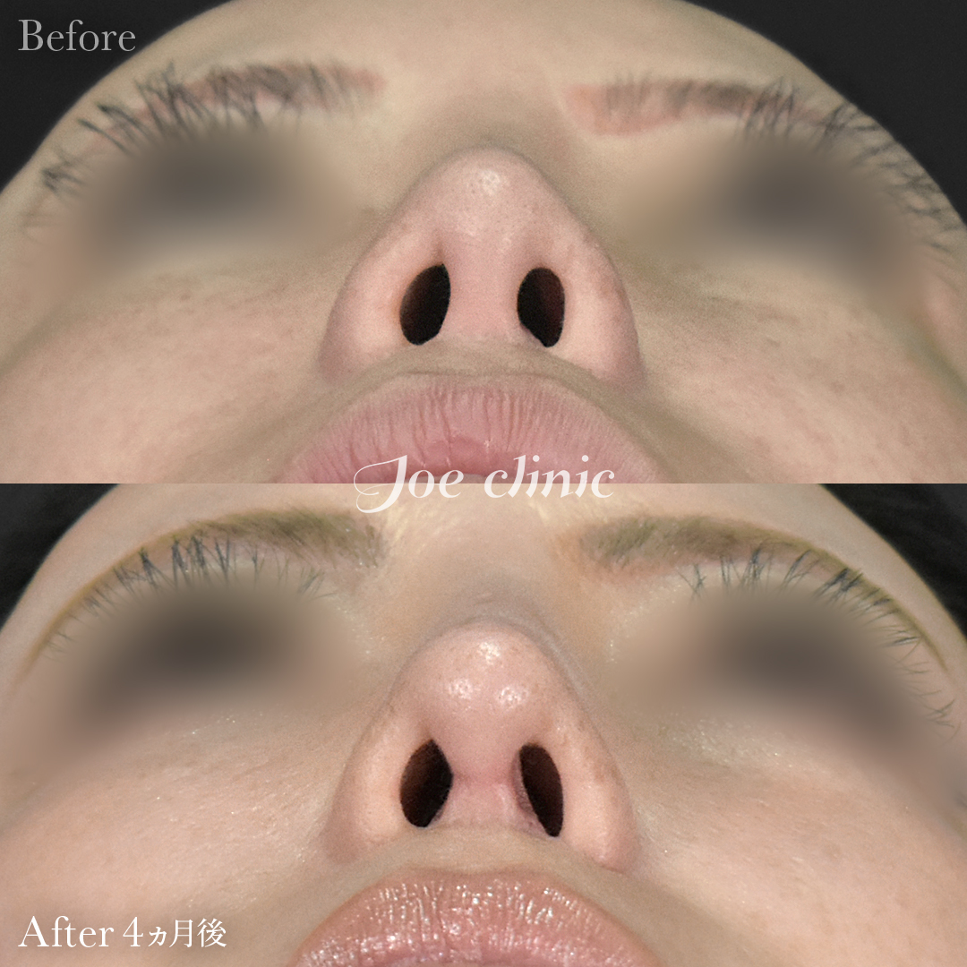 【50代女性・他院修正】他院鼻プロテーゼ入替＋鼻フルコース＋小鼻拡大術＋骨削り術（顎）＋顔の脂肪吸引＋脂肪注入｜4ヵ月後