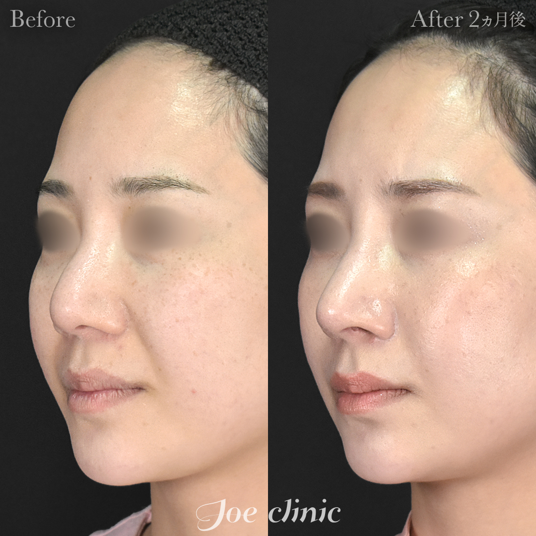 【30代女性・他院修正】他院鼻プロテーゼ入替＋他院異物除去＋鼻フルコース［クローズ法］（鼻複合自家組織移植術）｜2ヵ月後