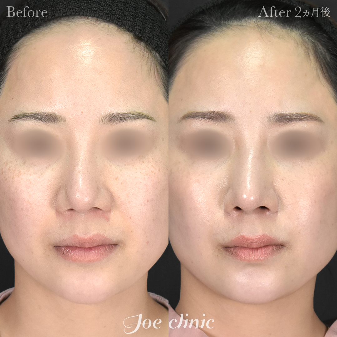 【30代女性・他院修正】他院鼻プロテーゼ入替＋他院異物除去＋鼻フルコース［クローズ法］（鼻複合自家組織移植術）｜2ヵ月後