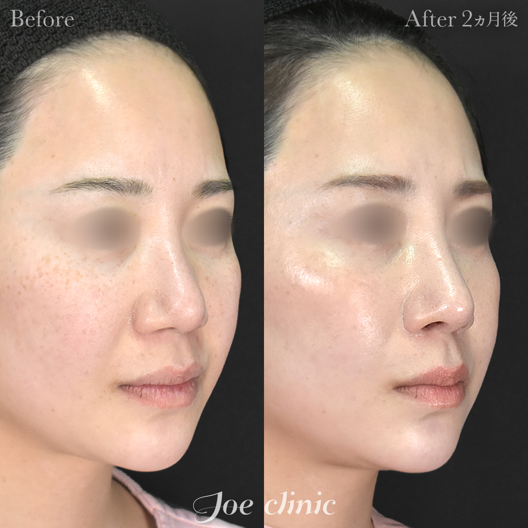 【30代女性・他院修正】他院鼻プロテーゼ入替＋他院異物除去＋鼻フルコース［クローズ法］（鼻複合自家組織移植術）｜2ヵ月後