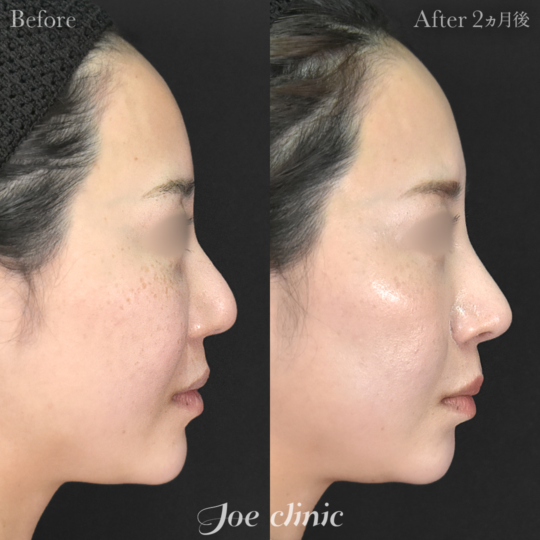 【30代女性・他院修正】他院鼻プロテーゼ入替＋他院異物除去＋鼻フルコース［クローズ法］（鼻複合自家組織移植術）｜2ヵ月後