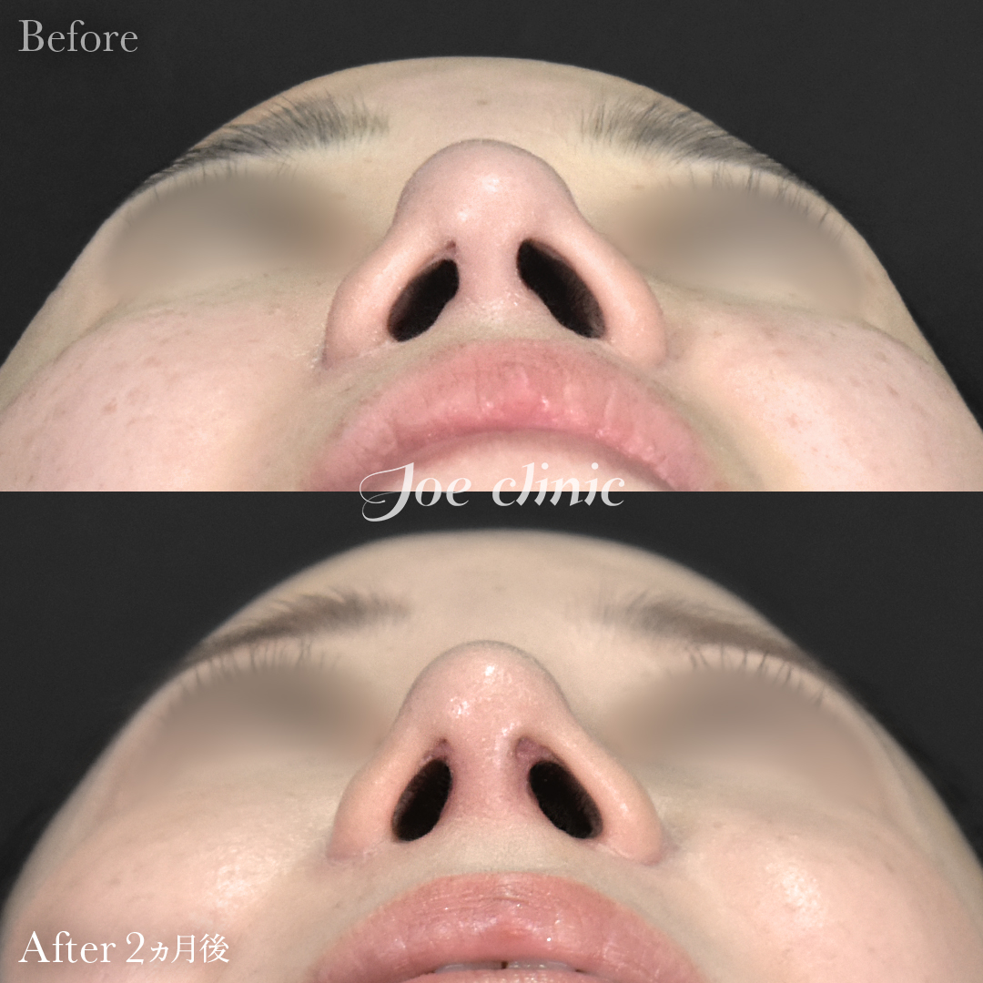 【30代女性・他院修正】他院鼻プロテーゼ入替＋他院異物除去＋鼻フルコース［クローズ法］（鼻複合自家組織移植術）｜2ヵ月後