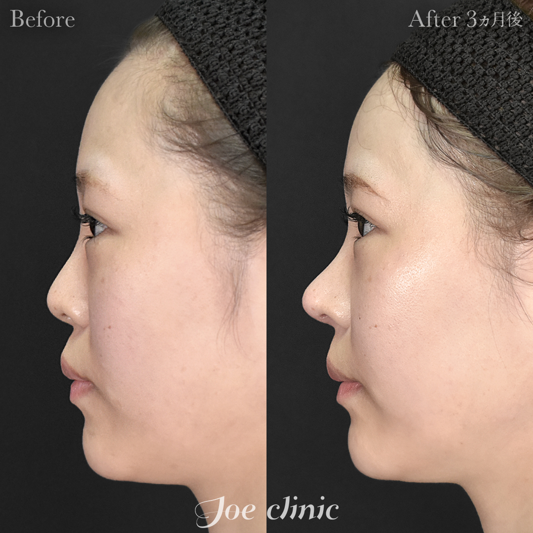 【20代女性・他院修正】他院鼻プロテーゼ入替＋鼻フルコース（鼻複合自家組織移植術）＋貴族手術（鼻翼基部プロテーゼ挿入術）｜3ヵ月後