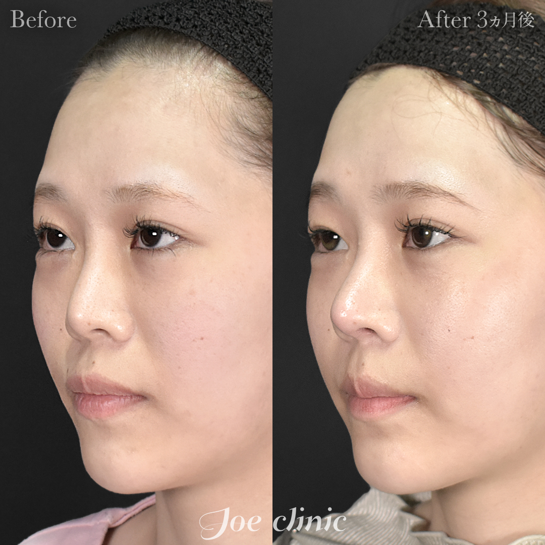 【20代女性・他院修正】他院鼻プロテーゼ入替＋鼻フルコース（鼻複合自家組織移植術）＋貴族手術（鼻翼基部プロテーゼ挿入術）｜3ヵ月後