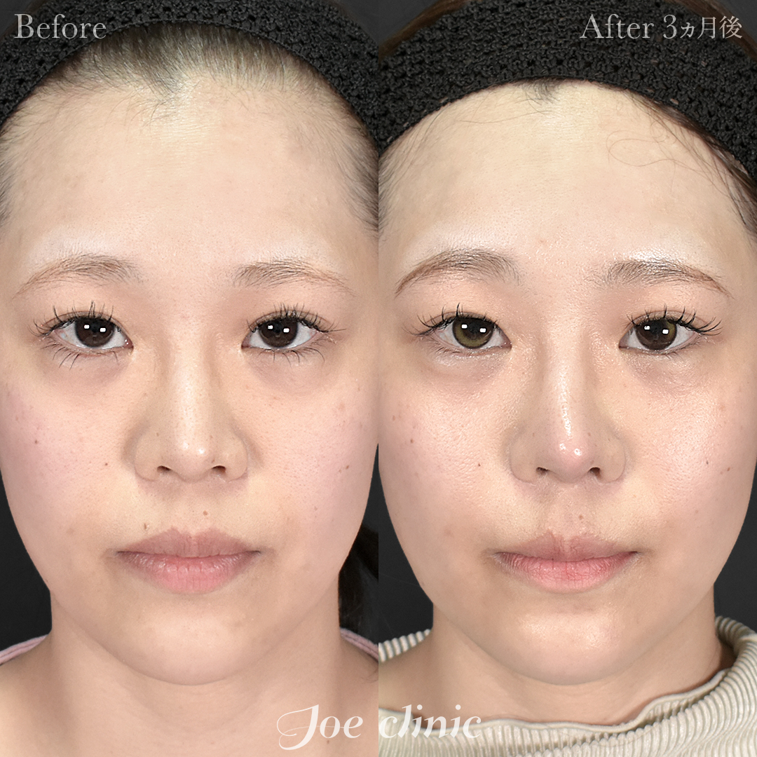 【20代女性・他院修正】他院鼻プロテーゼ入替＋鼻フルコース（鼻複合自家組織移植術）＋貴族手術（鼻翼基部プロテーゼ挿入術）｜3ヵ月後