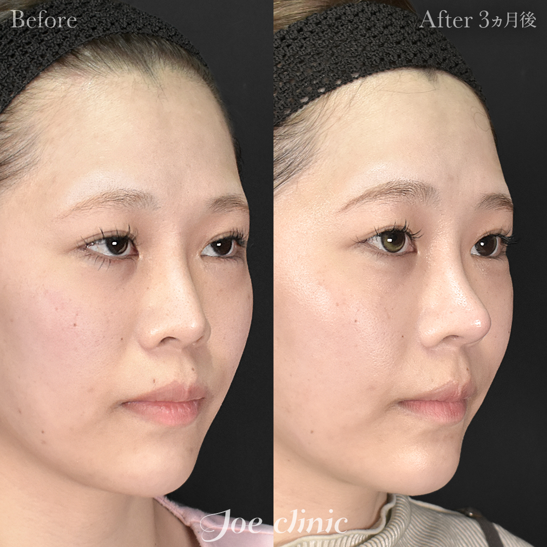 【20代女性・他院修正】他院鼻プロテーゼ入替＋鼻フルコース（鼻複合自家組織移植術）＋貴族手術（鼻翼基部プロテーゼ挿入術）｜3ヵ月後