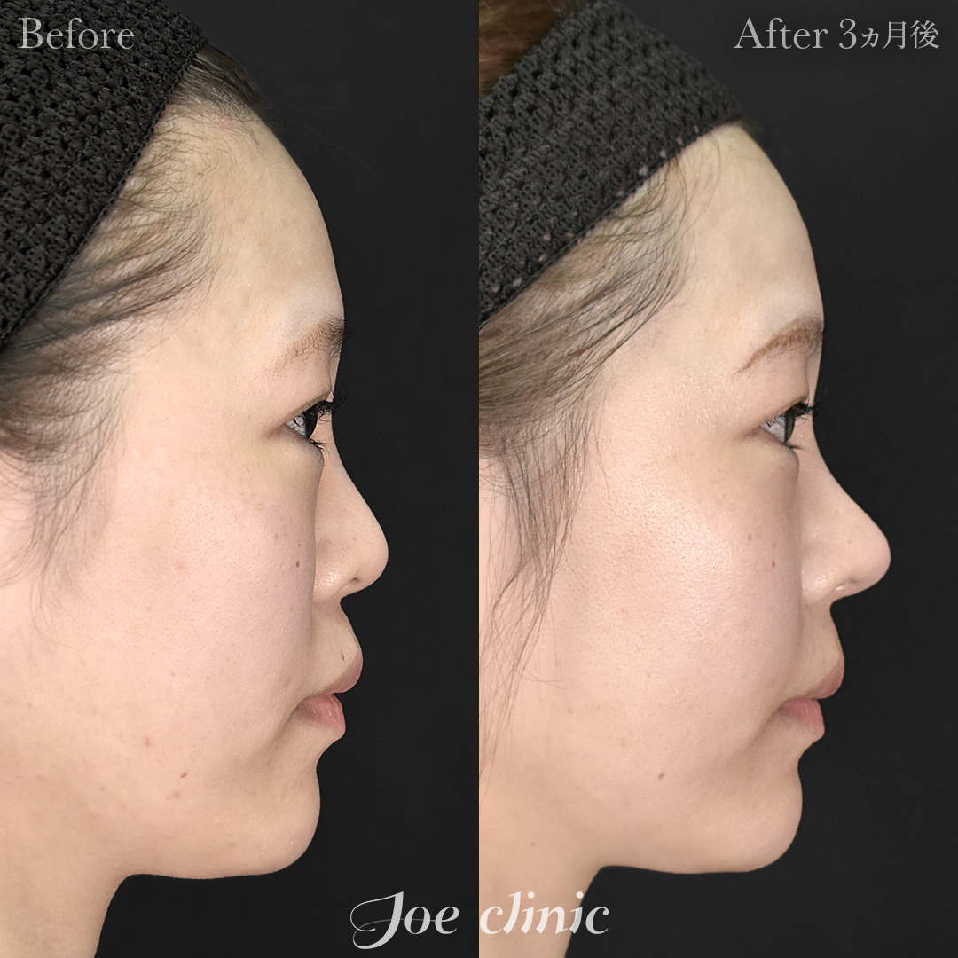 【20代女性・他院修正】他院鼻プロテーゼ入替＋鼻フルコース（鼻複合自家組織移植術）＋貴族手術（鼻翼基部プロテーゼ挿入術）｜3ヵ月後