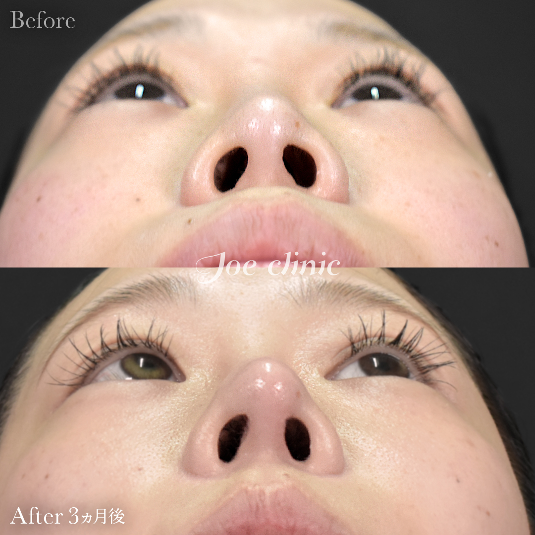 【20代女性・他院修正】他院鼻プロテーゼ入替＋鼻フルコース（鼻複合自家組織移植術）＋貴族手術（鼻翼基部プロテーゼ挿入術）｜3ヵ月後