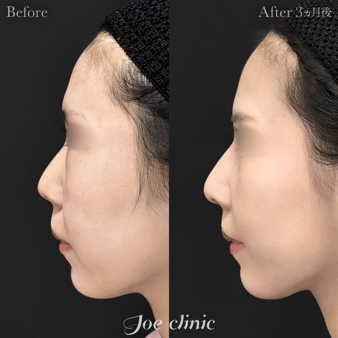 【20代女性】鼻フルコース（鼻複合自家組織移植術）＋鼻プロテーゼ挿入隆鼻術＋貴族フィラー（鼻翼基部ヒアルロン酸注入術）｜3ヵ月後