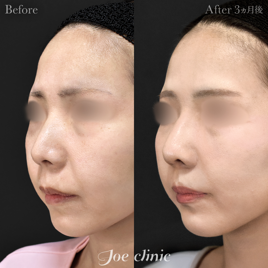 【20代女性】鼻フルコース(鼻複合自家組織移植術)+鼻プロテーゼ挿入隆鼻術+貴族フィラー(鼻翼基部ヒアルロン酸注入術)|3ヵ月後