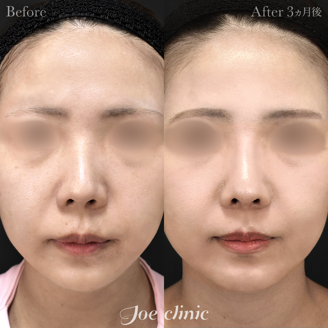 【20代女性】鼻フルコース(鼻複合自家組織移植術)+鼻プロテーゼ挿入隆鼻術+貴族フィラー(鼻翼基部ヒアルロン酸注入術)|3ヵ月後