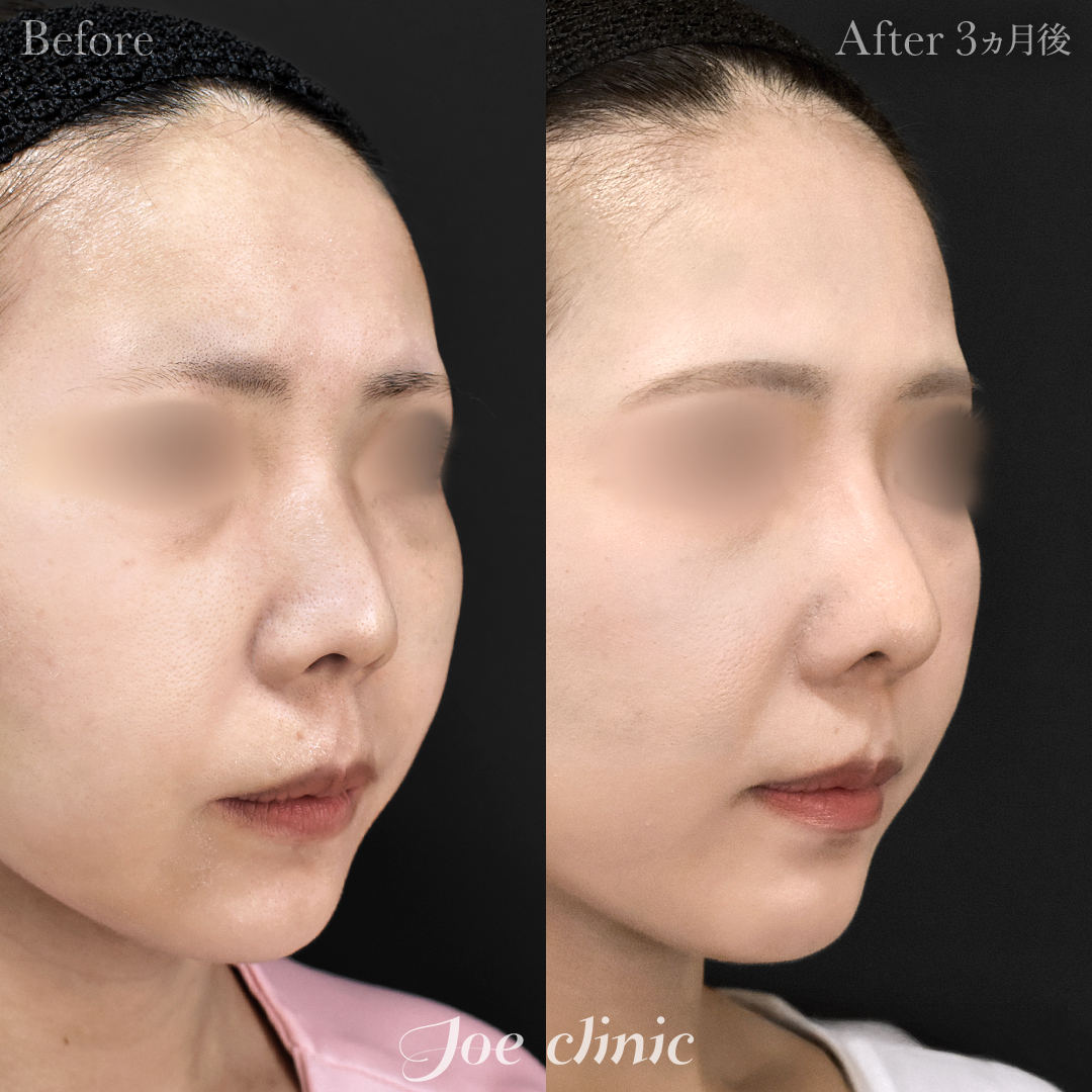 【20代女性】鼻フルコース(鼻複合自家組織移植術)+鼻プロテーゼ挿入隆鼻術+貴族フィラー(鼻翼基部ヒアルロン酸注入術)|3ヵ月後