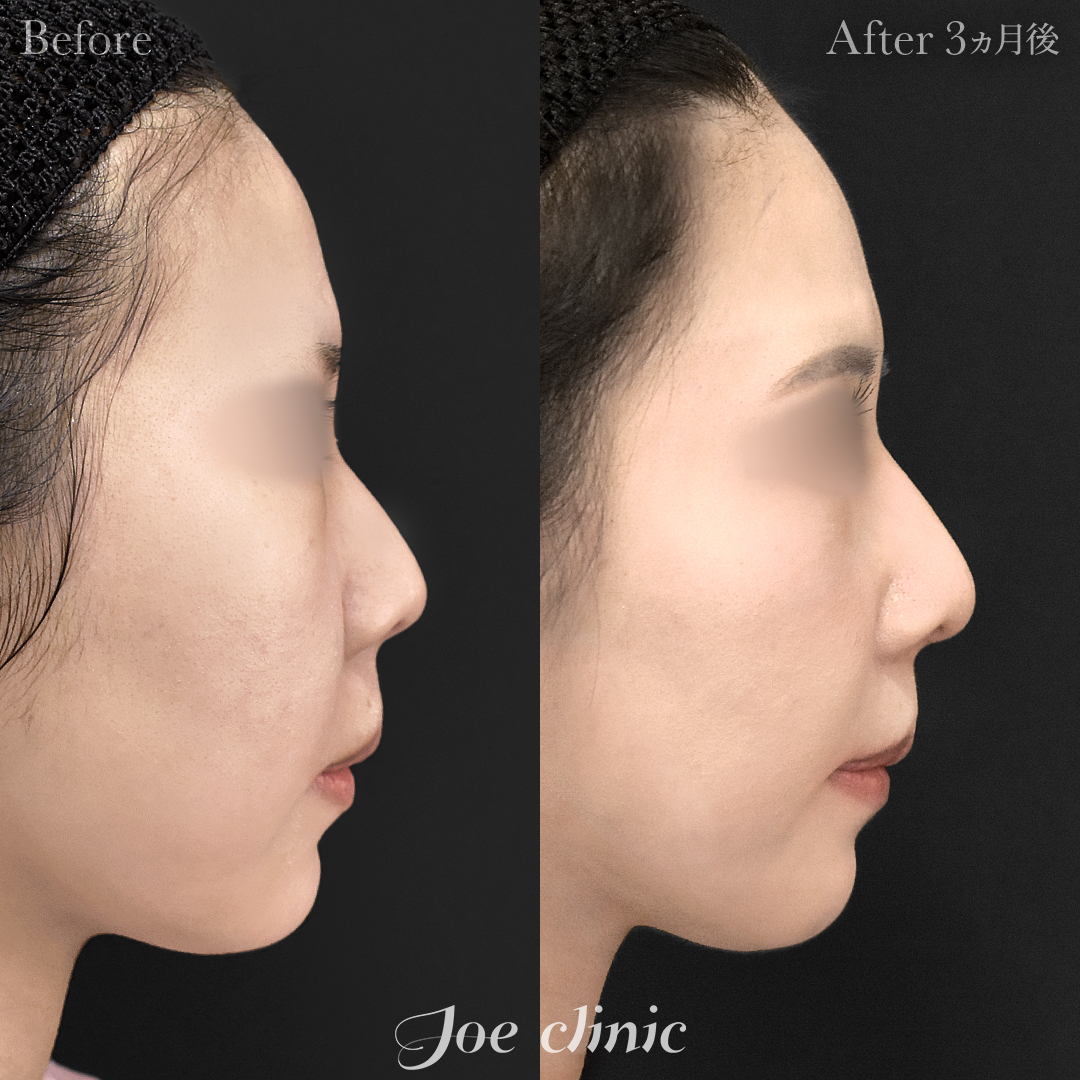 【20代女性】鼻フルコース(鼻複合自家組織移植術)+鼻プロテーゼ挿入隆鼻術+貴族フィラー(鼻翼基部ヒアルロン酸注入術)|3ヵ月後