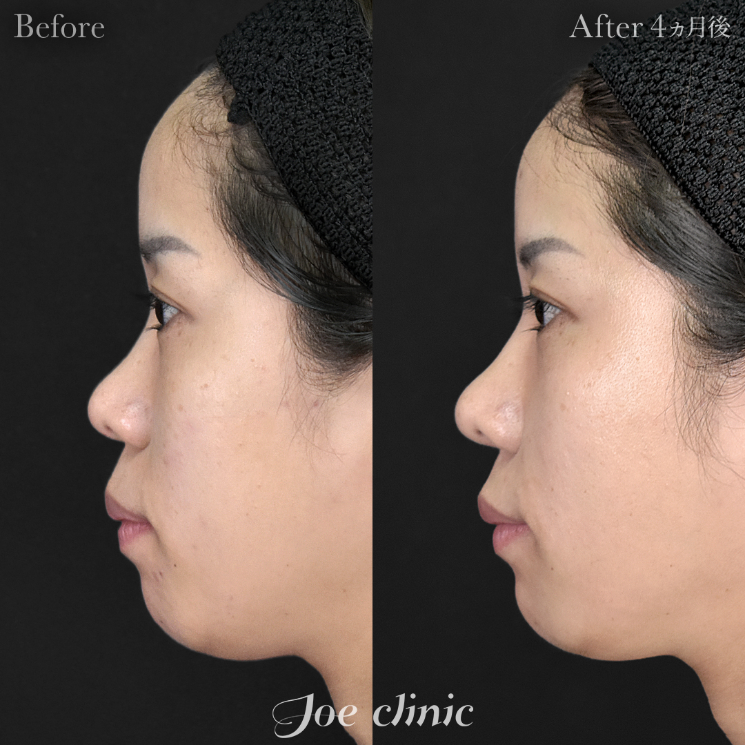 【20代女性】鼻フルコース（鼻複合自家組織移植術）＋筋膜移植＋貴族フィラー（鼻翼基部ヒアルロン酸注入術）｜4ヵ月後