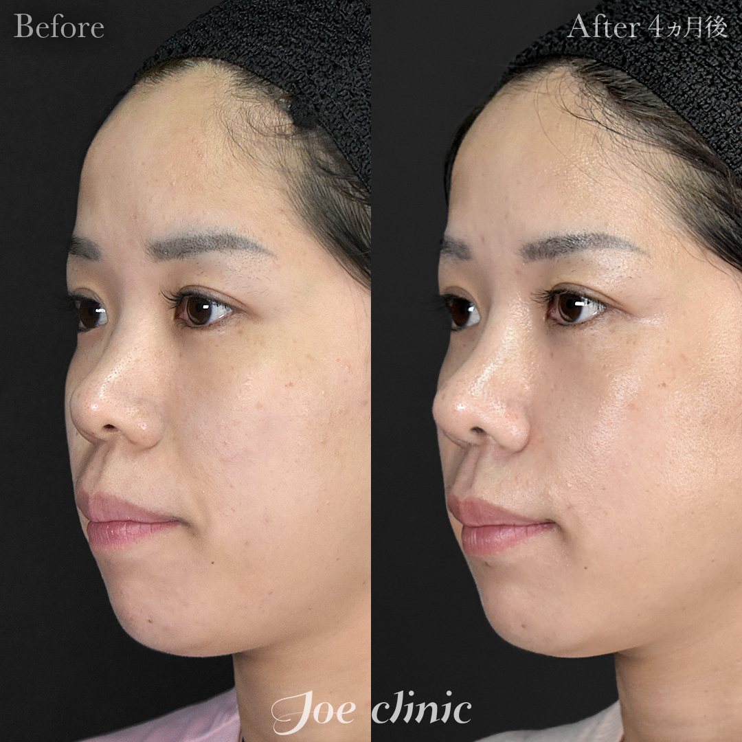 【20代女性】鼻フルコース(鼻複合自家組織移植術)+筋膜移植+貴族フィラー(鼻翼基部ヒアルロン酸注入術)|4ヵ月後