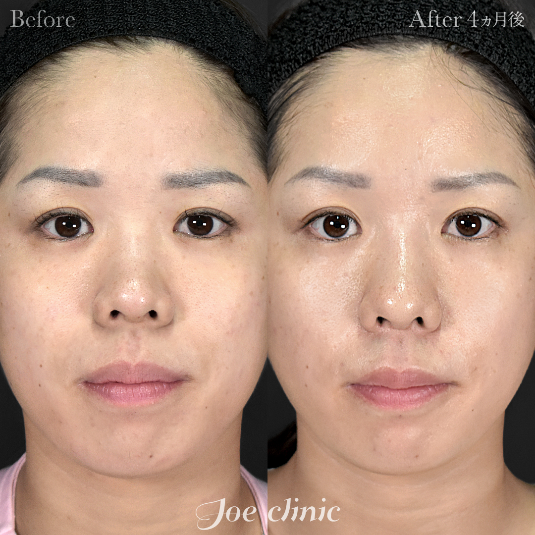 【20代女性】鼻フルコース(鼻複合自家組織移植術)+筋膜移植+貴族フィラー(鼻翼基部ヒアルロン酸注入術)|4ヵ月後