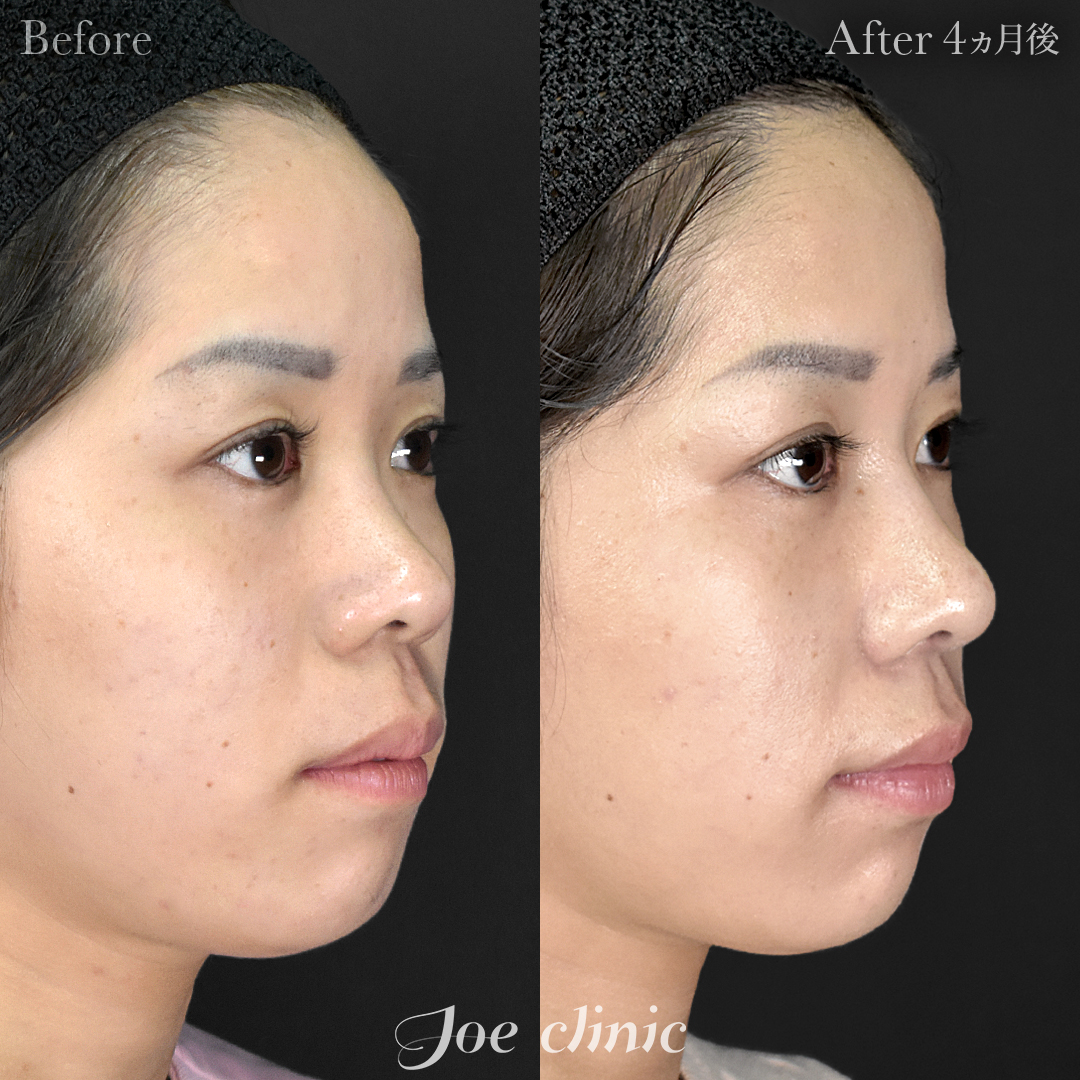 【20代女性】鼻フルコース(鼻複合自家組織移植術)+筋膜移植+貴族フィラー(鼻翼基部ヒアルロン酸注入術)|4ヵ月後