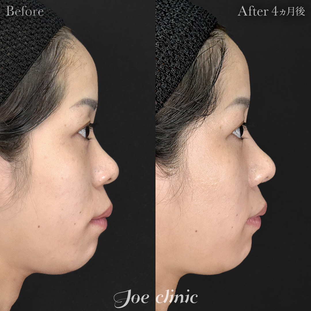 【20代女性】鼻フルコース(鼻複合自家組織移植術)+筋膜移植+貴族フィラー(鼻翼基部ヒアルロン酸注入術)|4ヵ月後
