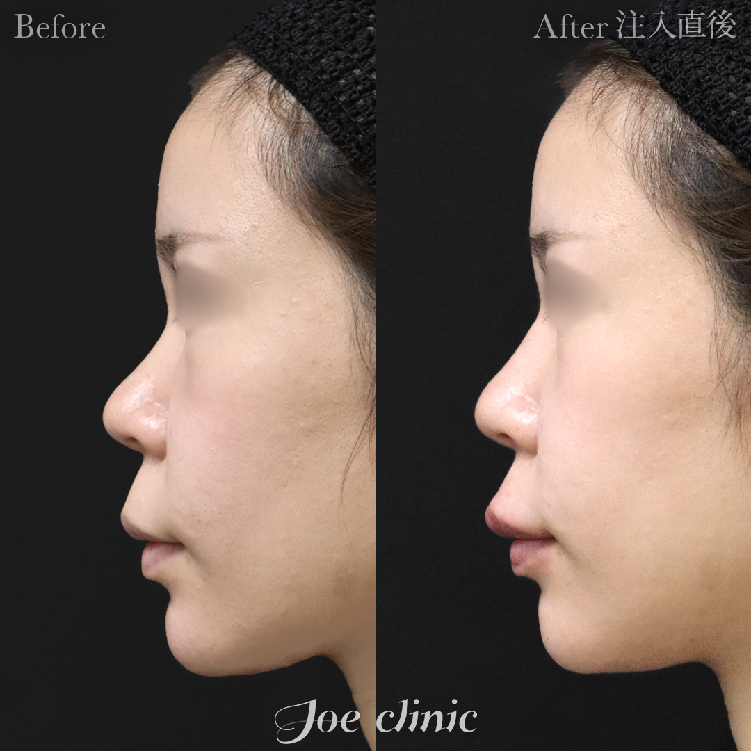 【20代女性】鼻ヒアルロン酸注入隆鼻術｜注入直後