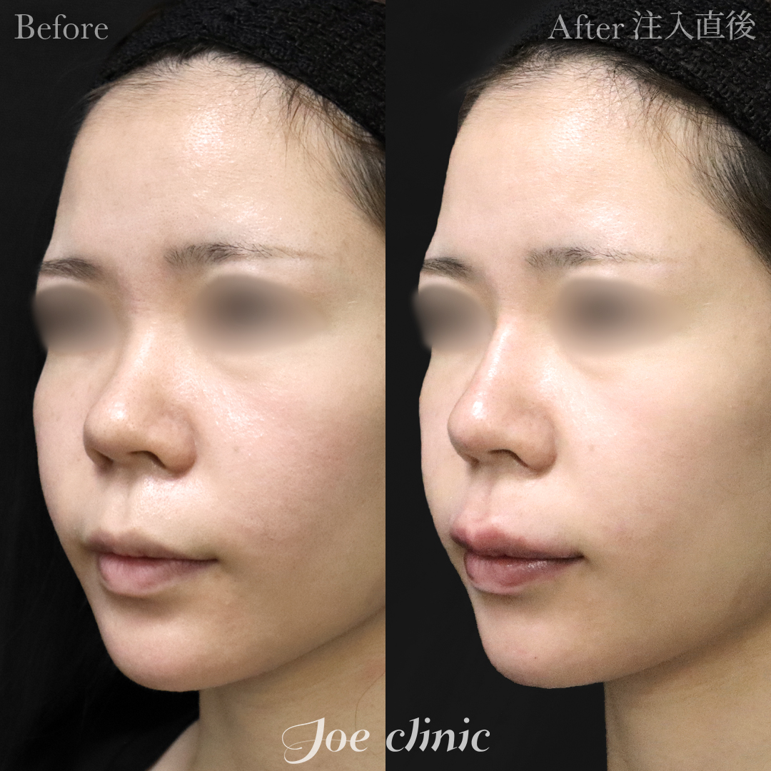 【20代女性】鼻ヒアルロン酸注入隆鼻術｜注入直後