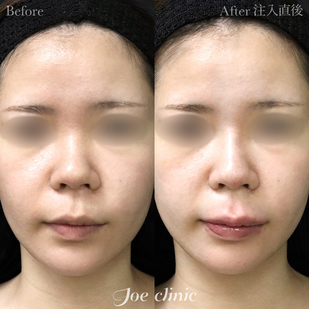 【20代女性】鼻ヒアルロン酸注入隆鼻術｜注入直後