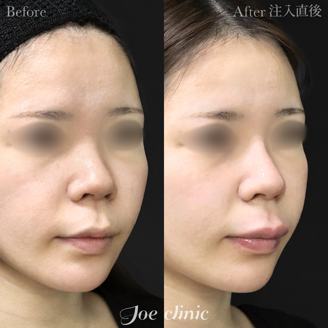 【20代女性】鼻ヒアルロン酸注入隆鼻術｜注入直後