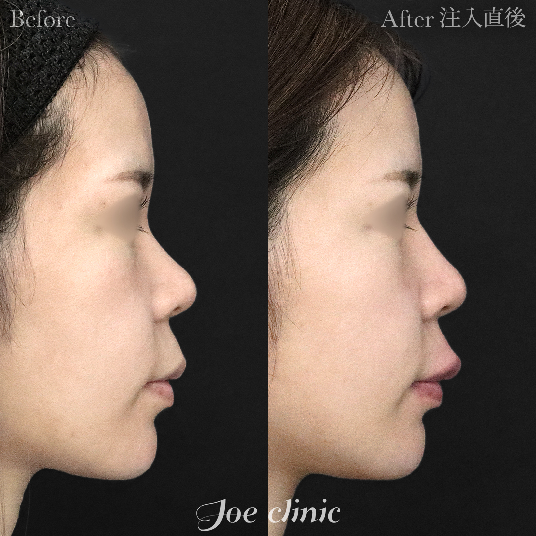 【20代女性】鼻ヒアルロン酸注入隆鼻術｜注入直後