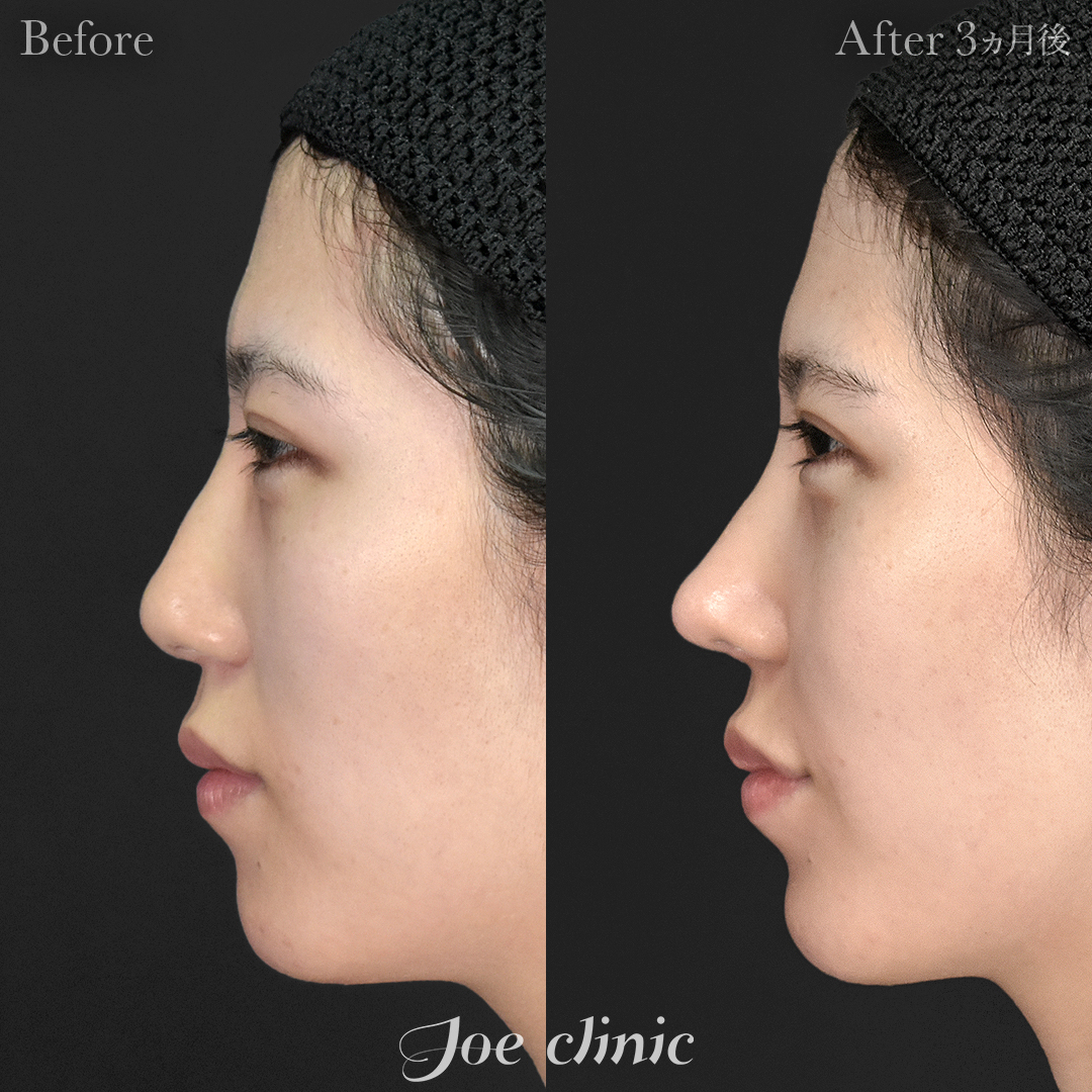 【20代女性】鼻フルコース(鼻複合自家組織移植術)+筋膜移植|3ヵ月後
