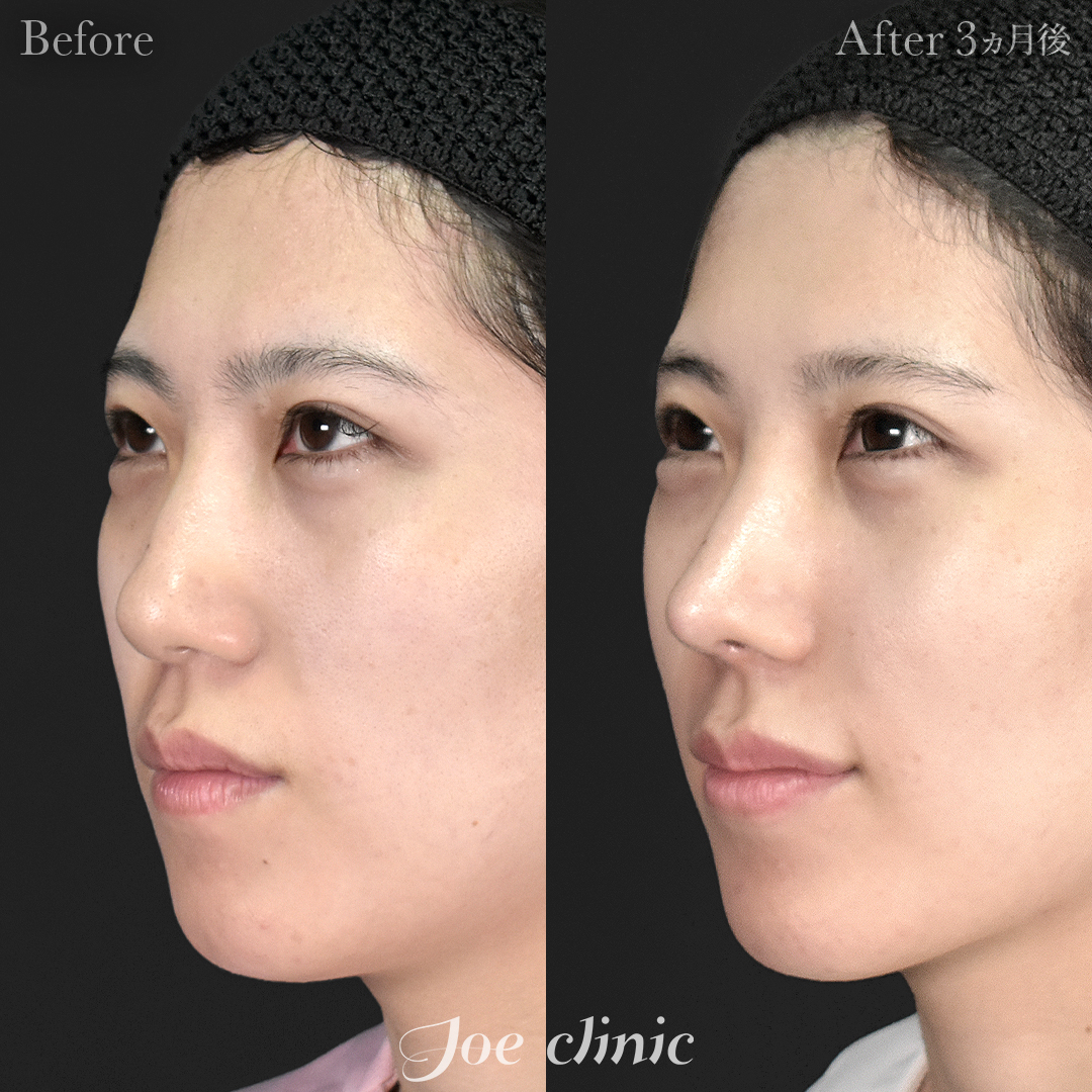 【20代女性】鼻フルコース（鼻複合自家組織移植術）＋筋膜移植｜3ヵ月後