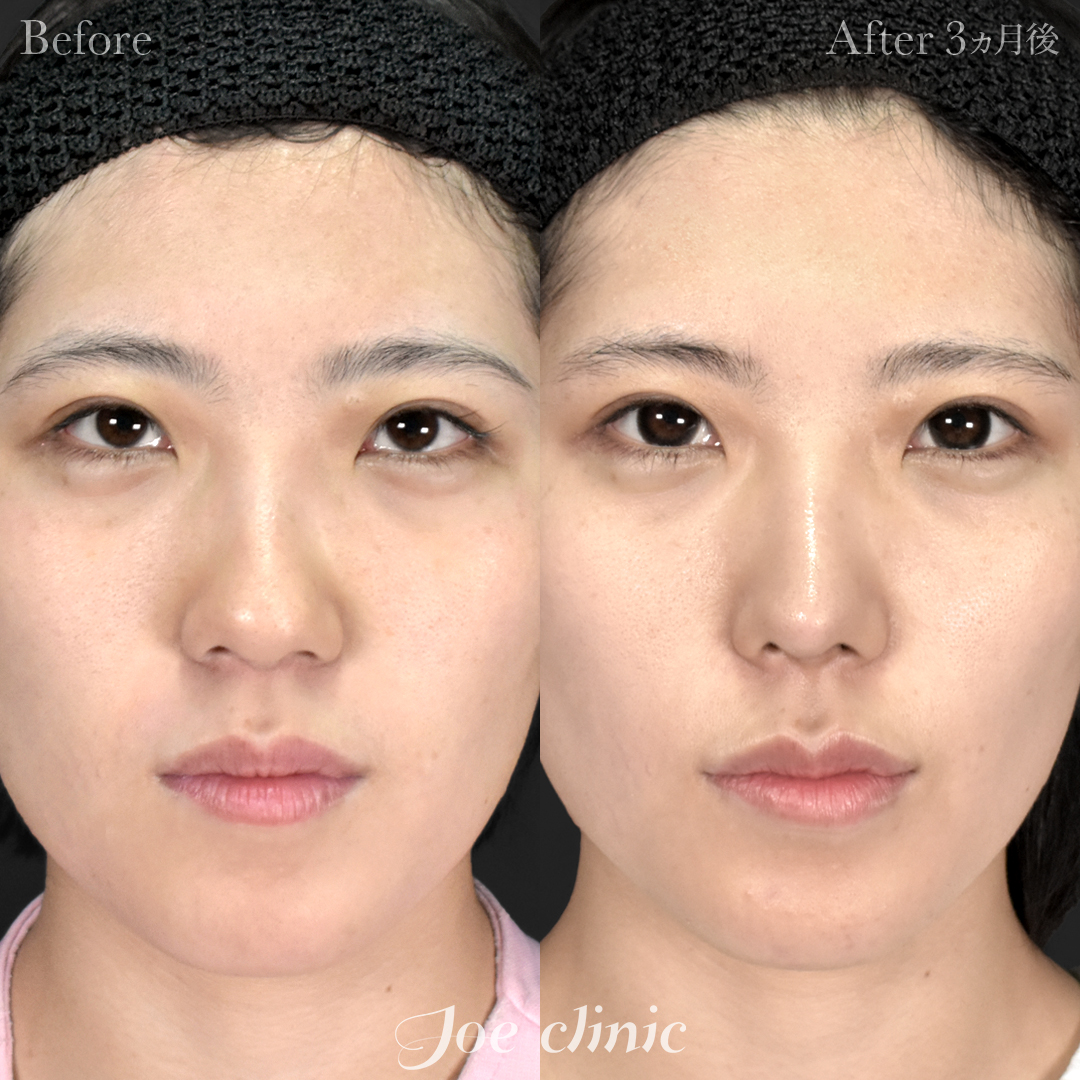 【20代女性】鼻フルコース（鼻複合自家組織移植術）＋筋膜移植｜3ヵ月後