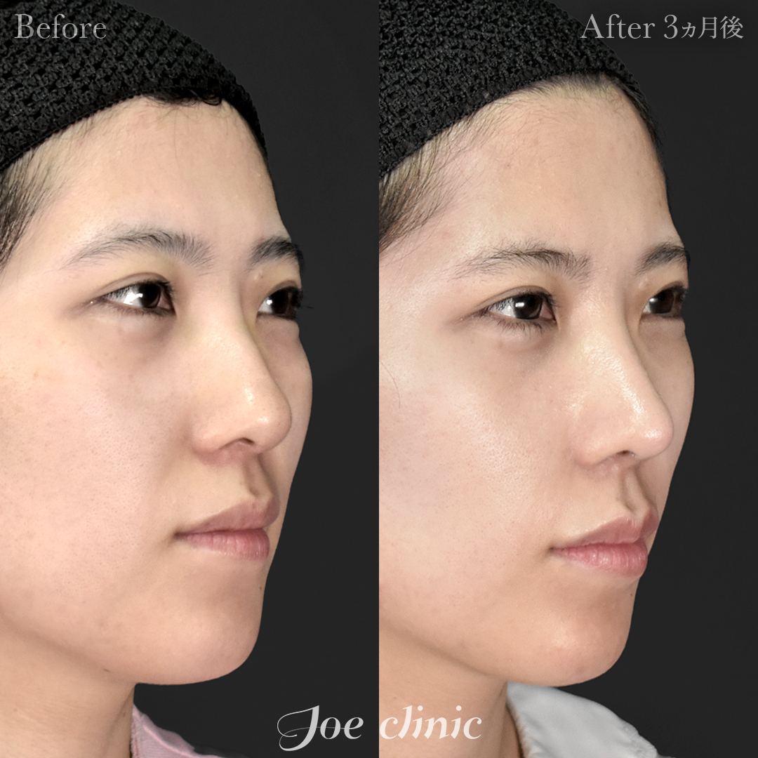 【20代女性】鼻フルコース（鼻複合自家組織移植術）＋筋膜移植｜3ヵ月後