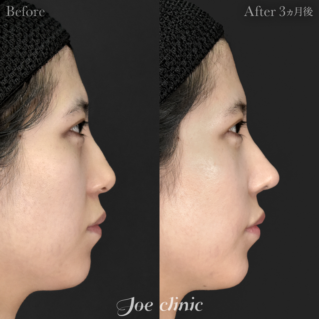 【20代女性】鼻フルコース（鼻複合自家組織移植術）＋筋膜移植｜3ヵ月後