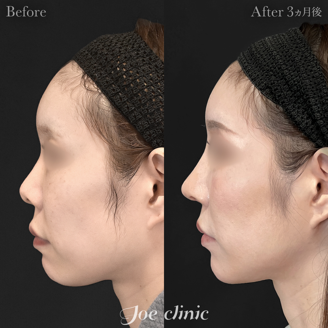 【30代女性】鼻フルコース(鼻複合自家組織移植術)+顔の脂肪吸引(顔全体)|3ヵ月後