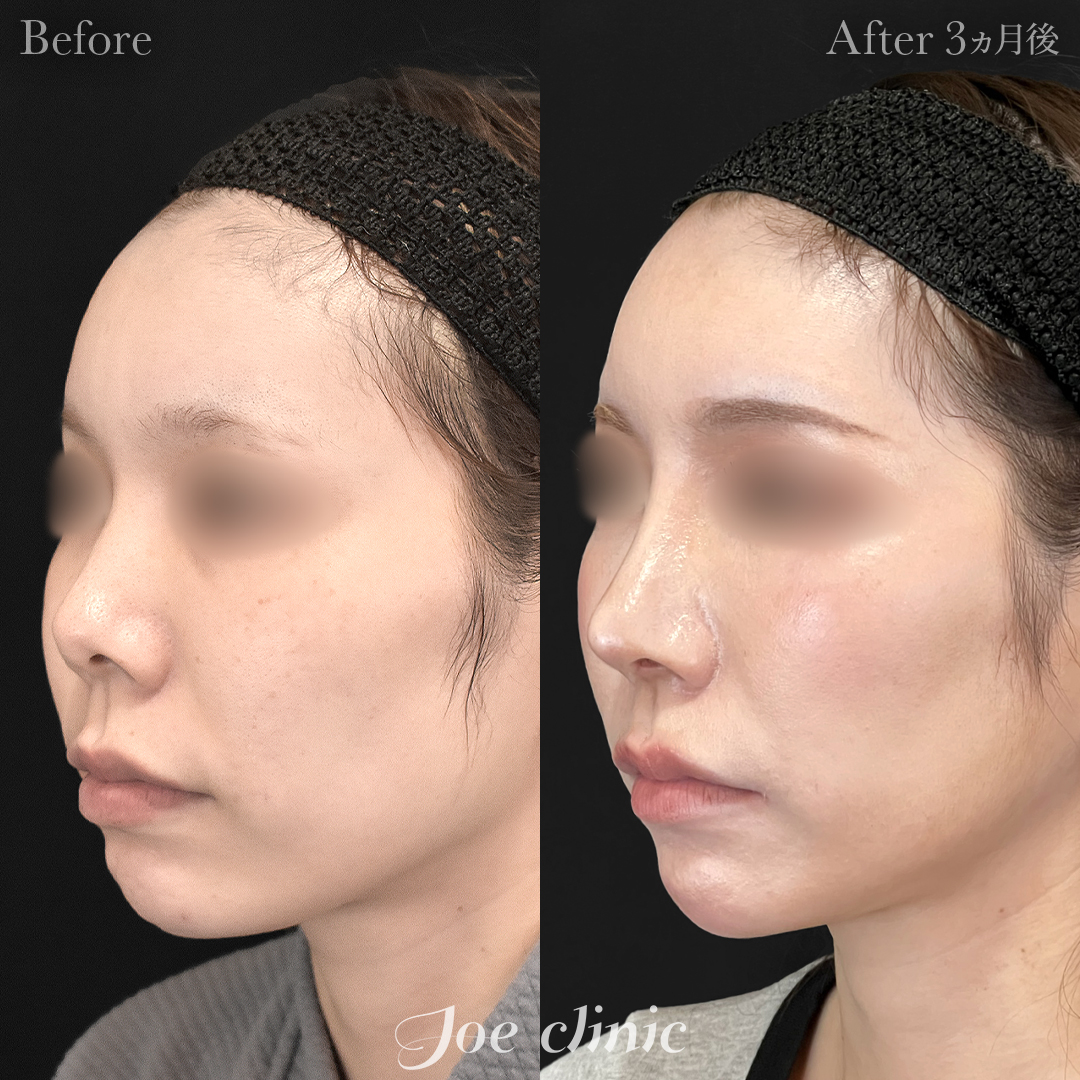 【30代女性】鼻フルコース(鼻複合自家組織移植術)+顔の脂肪吸引(顔全体)|3ヵ月後