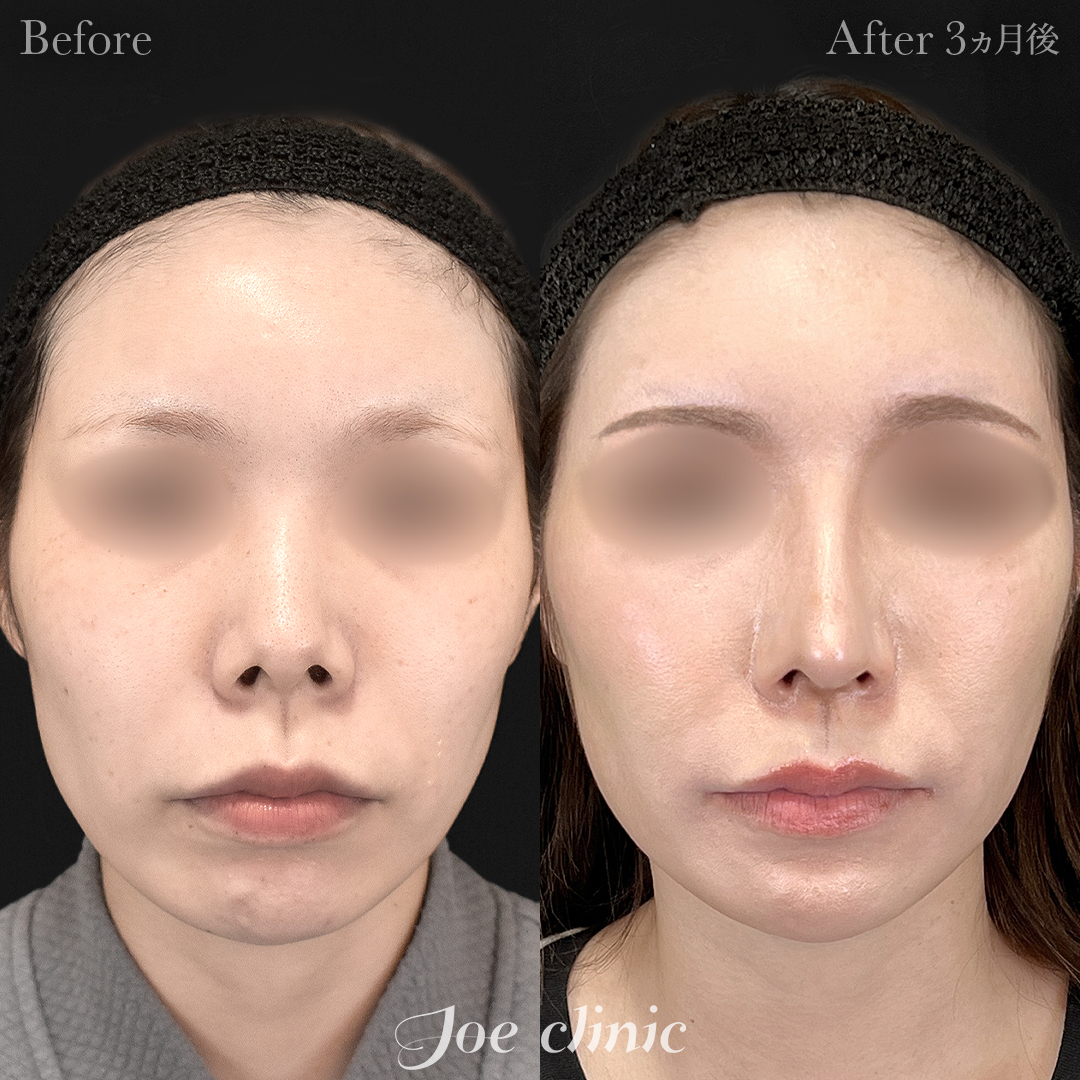【30代女性】鼻フルコース(鼻複合自家組織移植術)+顔の脂肪吸引(顔全体)|3ヵ月後