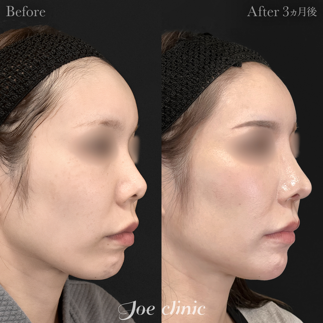 【30代女性】鼻フルコース(鼻複合自家組織移植術)+顔の脂肪吸引(顔全体)|3ヵ月後