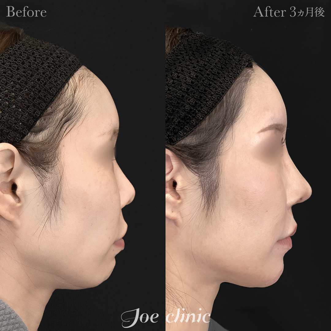 【30代女性】鼻フルコース(鼻複合自家組織移植術)+顔の脂肪吸引(顔全体)|3ヵ月後