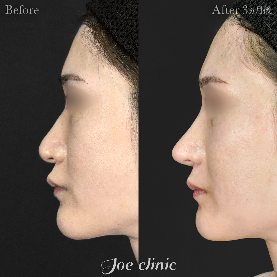 【30代女性・他院修正】鼻フルコース［クローズ法］（鼻複合自家組織移植術）＋筋膜移植｜3ヵ月後