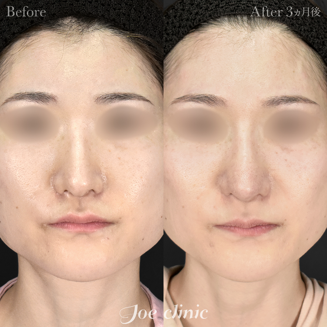 【30代女性・他院修正】鼻フルコース［クローズ法］（鼻複合自家組織移植術）＋筋膜移植｜3ヵ月後