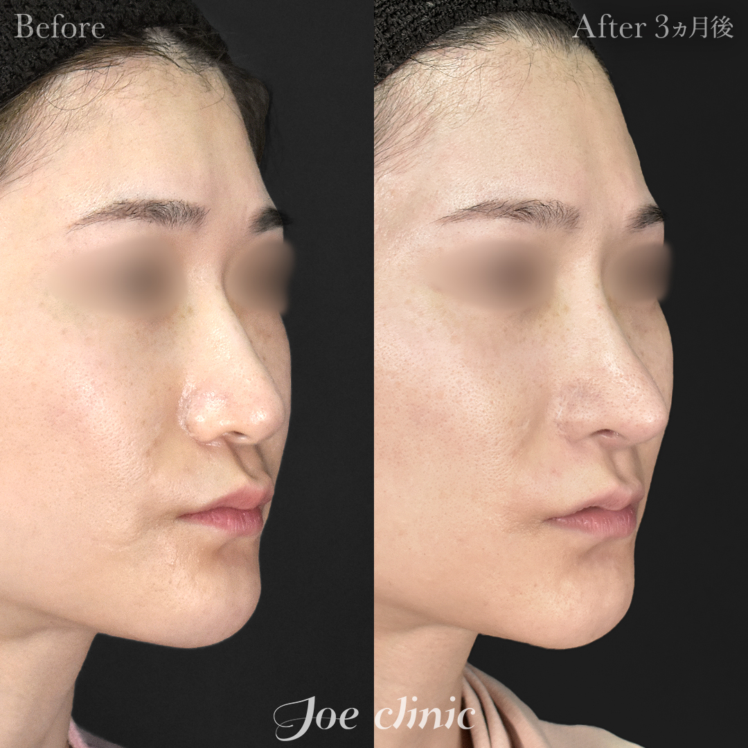 【30代女性・他院修正】鼻フルコース［クローズ法］（鼻複合自家組織移植術）＋筋膜移植｜3ヵ月後