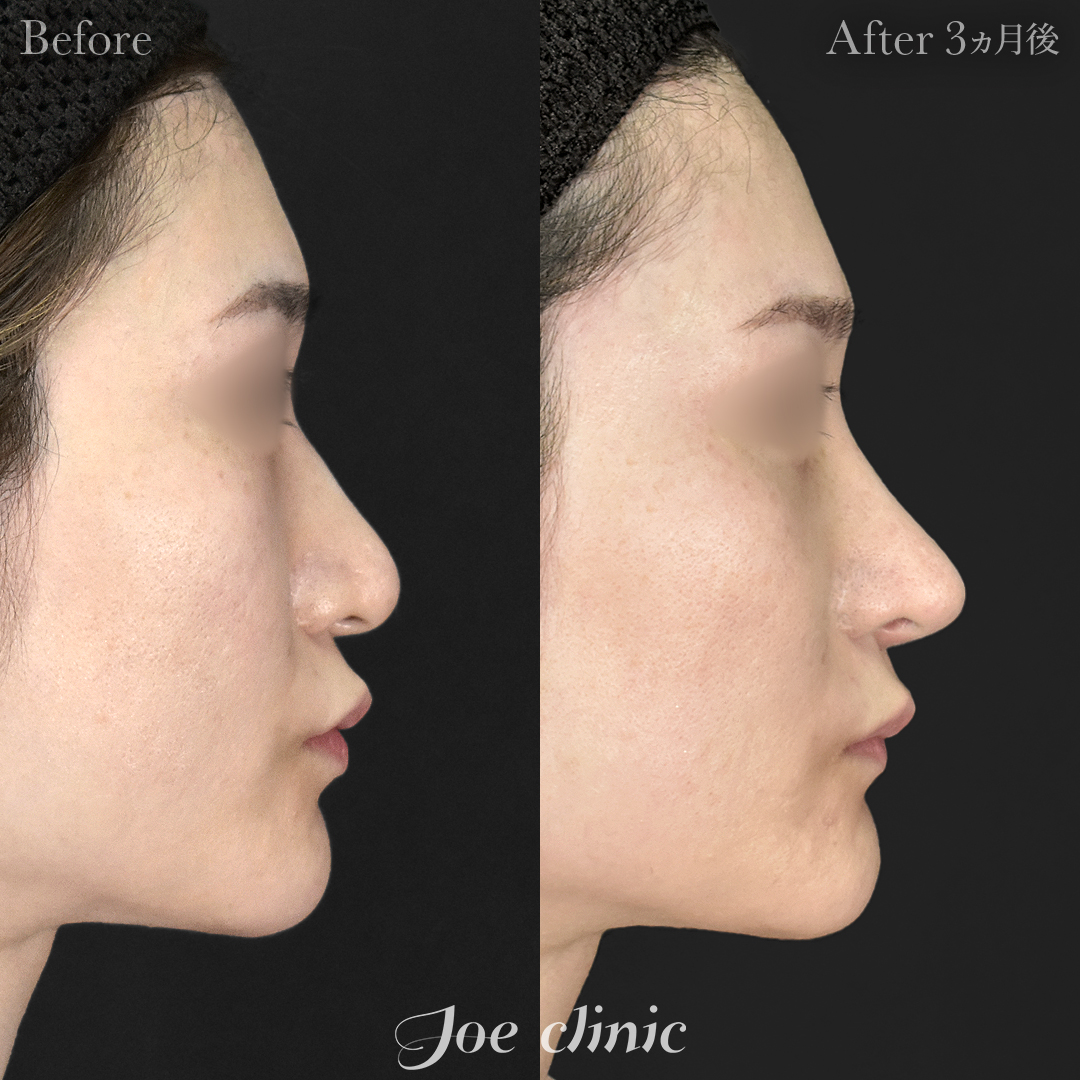 【30代女性・他院修正】鼻フルコース［クローズ法］（鼻複合自家組織移植術）＋筋膜移植｜3ヵ月後