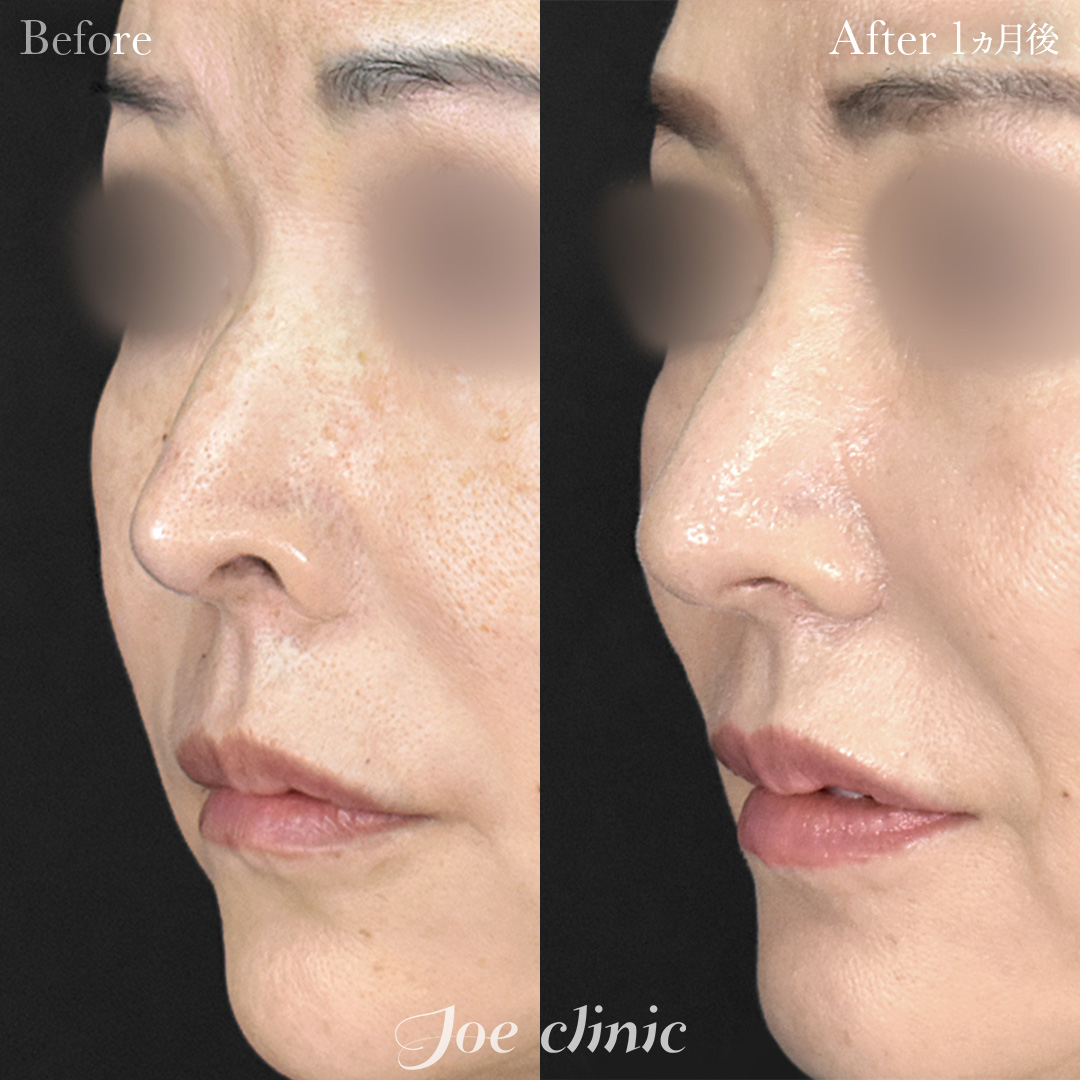【60代女性】鼻孔縁下降術（コンポジットグラフト）｜1ヵ月後