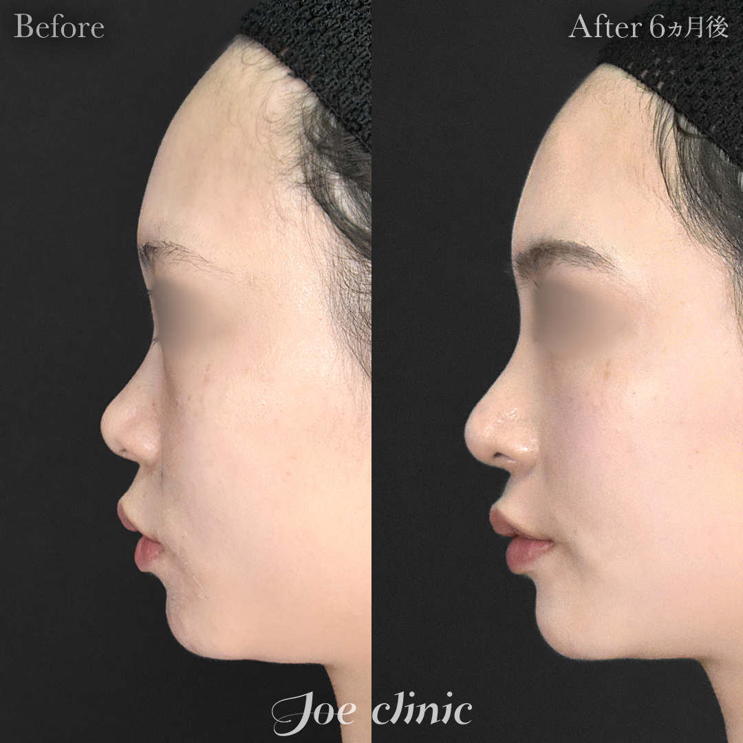 【20代女性】鼻フルコース（鼻複合自家組織移植術）＋鼻プロテーゼ挿入隆鼻術｜6ヵ月後