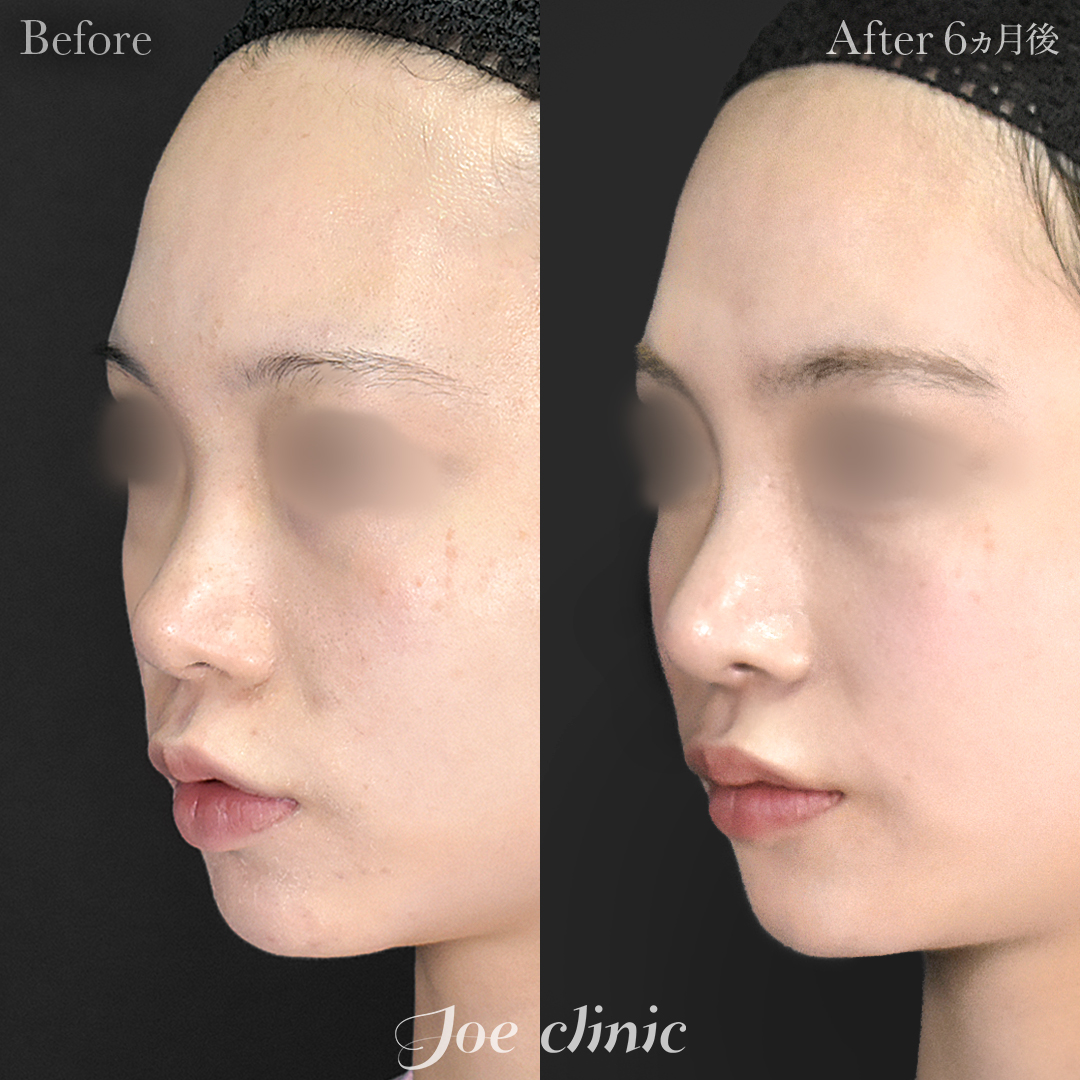 【20代女性】鼻フルコース(鼻複合自家組織移植術)+鼻プロテーゼ挿入隆鼻術|6ヵ月後