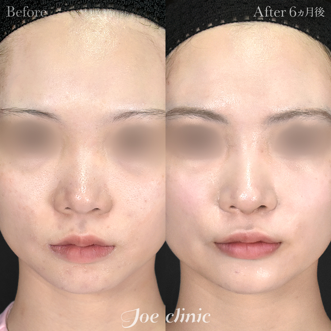 【20代女性】鼻フルコース(鼻複合自家組織移植術)+鼻プロテーゼ挿入隆鼻術|6ヵ月後