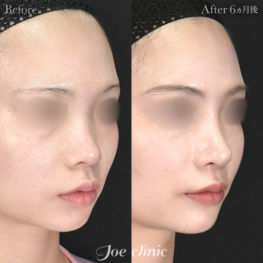 【20代女性】鼻フルコース(鼻複合自家組織移植術)+鼻プロテーゼ挿入隆鼻術|6ヵ月後