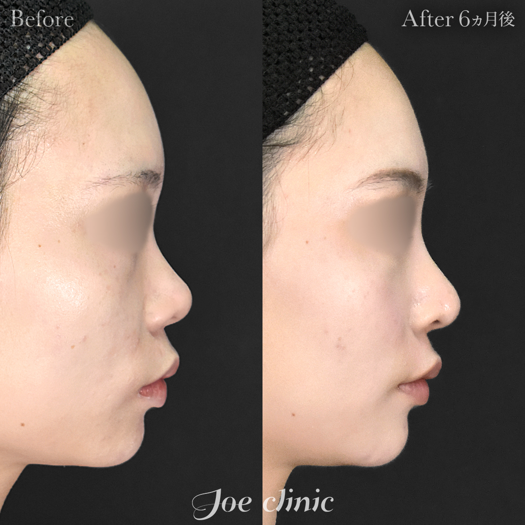 【20代女性】鼻フルコース(鼻複合自家組織移植術)+鼻プロテーゼ挿入隆鼻術|6ヵ月後