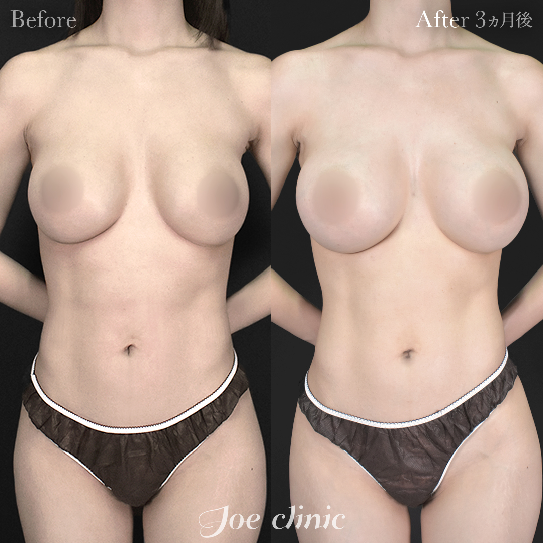 【30代女性・他院修正】他院バッグ入れ替え(535cc×左右)|3ヵ月後