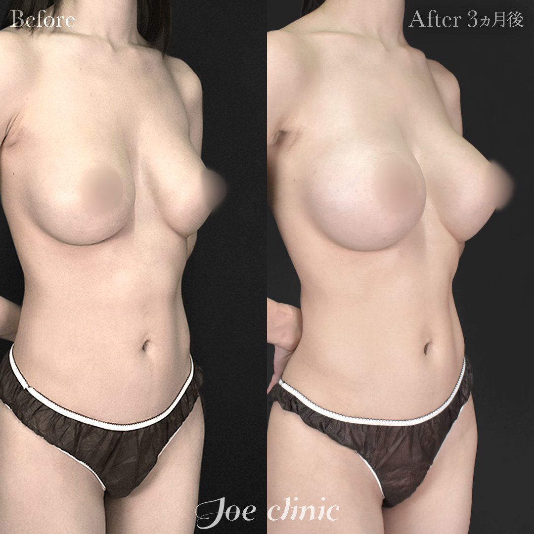 【30代女性・他院修正】他院バッグ入れ替え(535cc×左右)|3ヵ月後